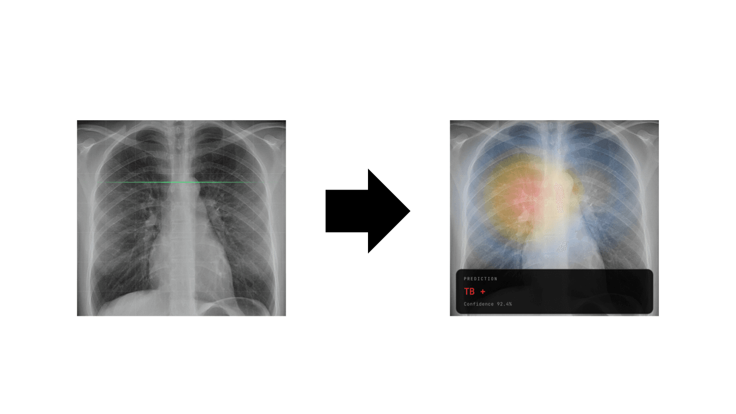TB Detect AI preview